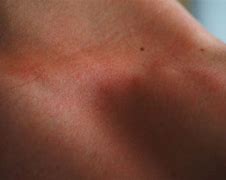 Image result for Sunburn Itch