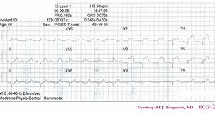 Image result for Possible Anterior Myocardial Infarction ECG