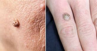 Image result for Flat Warts On Arm