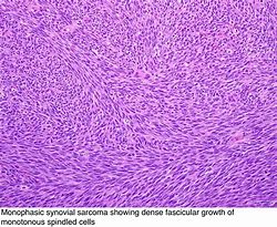 Image result for Synovial Sarcoma