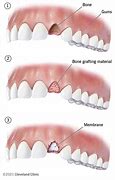 Image result for Swelling After Dental Bone Graft