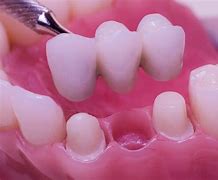 Image result for Dental Bridge Example