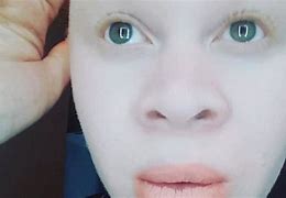 Image result for albinl