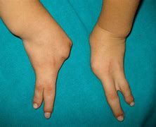 Image result for Ectrodactyly