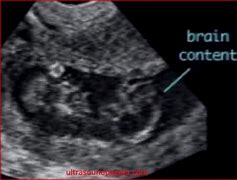 Image result for Craniorachischisis Newborn