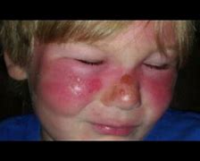 Image result for Second-Degree Burn Face