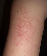 Image result for Ingrown Hair On Arm