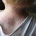 Image result for Rash with Strep Throat