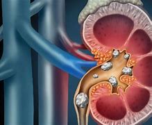 Image result for Kidney Stone Stent Placement