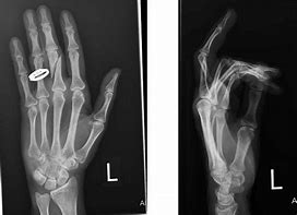 Image result for Smashed Finger Swollen
