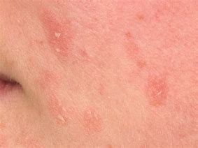 Image result for dermatosis