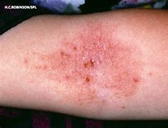 Image result for Eczema in Scalp