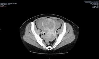 Image result for Stomach with Fibroids