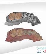 Image result for Fixed Partial Denture Impression