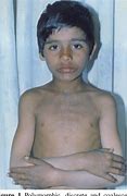 Image result for Epidermodysplasia Verruciformis Treatment