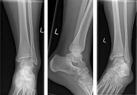 Image result for Ankle Joint Fracture