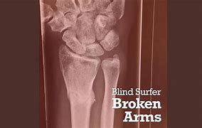 Image result for Broken Stick Out of Arm