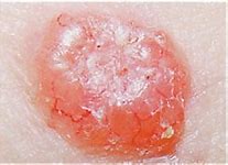 Image result for Basal Cell Carcinoma Telangiectasia