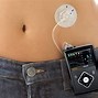 Image result for Insulin Pump Systems Features Comparison Chart