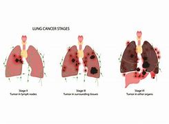Image result for Stage 3 Lung Cancer Prognosis