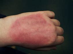 Image result for Burn Marks On Skin