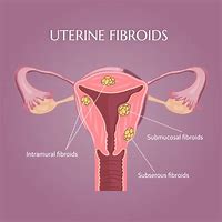 Image result for Fibroid Tumor in Cervix