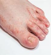 Image result for Rash On Bottom of Feet