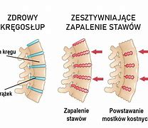 Image result for co_to_za_zapalenie_tkanki_Łącznej