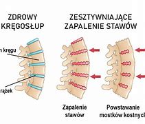 Image result for co_to_znaczy_zapalenie_tkanki_Łącznej