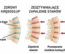 Image result for co_to_znaczy_zapalenie_kręgosłupa