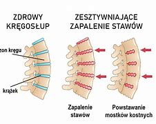 Image result for co_oznacza_zesztywniające_zapalenie_stawów_kręgosłupa