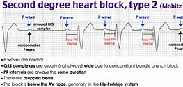 Image result for Mobitz Type 2 with STEMI