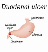 Image result for Duodenum Pain