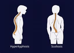 Image result for Kyphosis vs Scoliosis