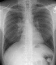 Image result for Histoplasmosis X-ray Images