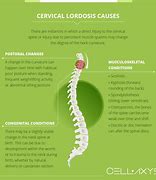 Image result for Cervical Spine Lordosis