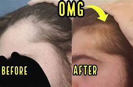 Image result for Unwanted Hair Growth in Minoxidil