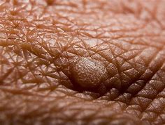 Image result for Cervical Warts