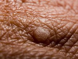 Image result for Female HPV Warts