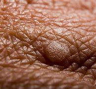 Image result for What Are Warts