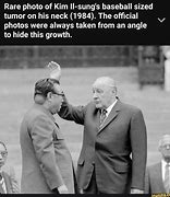 Image result for Baseball-Sized Lung Cancer Tumor