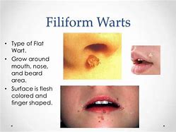 Image result for Filiform Wart Mouth