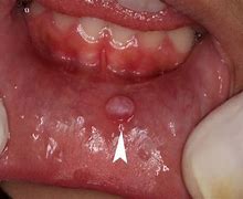 Image result for Wart Removal Patches
