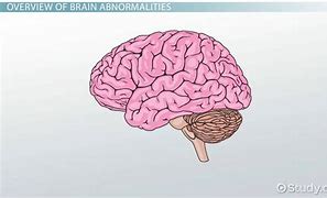 Image result for Brain Abnormalities