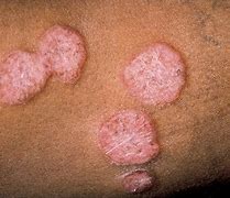 Image result for Circular Lesions On Skin