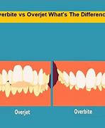 Image result for Overjet and Overbite Definition