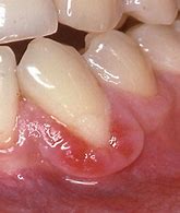 Image result for Gingival Mass