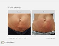 Image result for Radio Frequency Skin Tightening Diagram