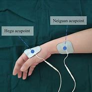 Image result for Transcutaneous Electrical Acupoint Stimulation