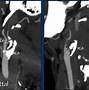 Image result for Carotid Doppler Stenosis Ultrasound Radiology